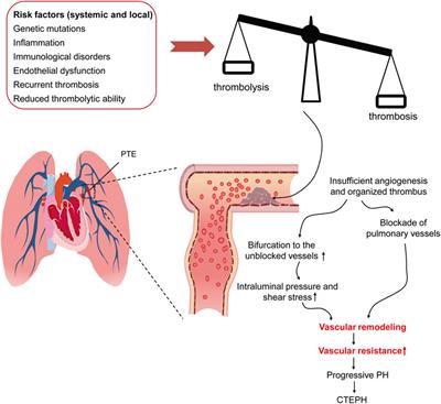 In situ Pulmonary Artery Thrombosis: A Previously Overlooked Disease